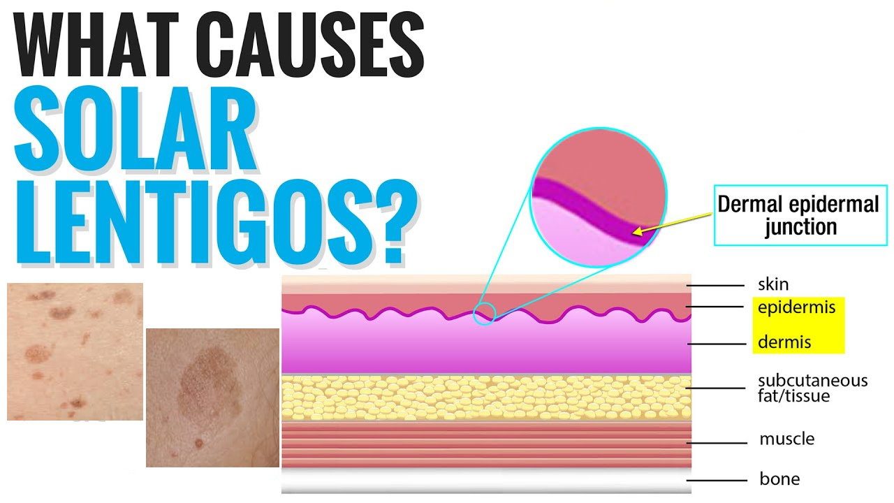 孚美达“氟轻松氢醌维A酸乳膏”能用于老年斑治疗吗？