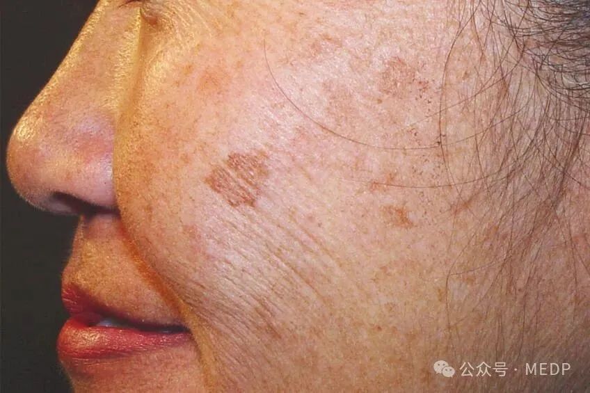 老年斑、晒斑、日光性雀斑是一回事吗？